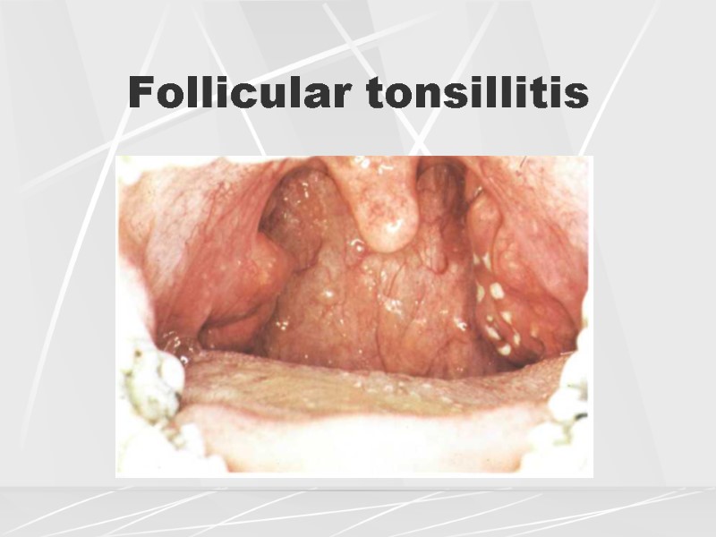 Follicular tonsillitis